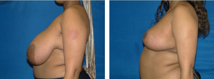 Breast Reduction Before & After Gallery - Patient 74827282 - Image 2
