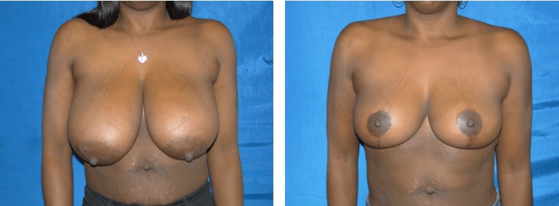 Breast Reduction Before & After Gallery - Patient 74827283 - Image 1