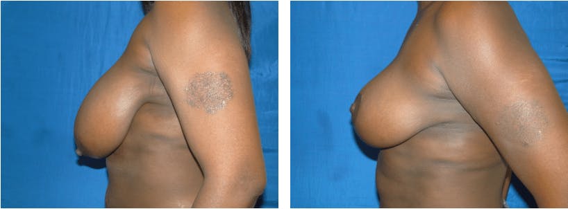 Breast Reduction Before & After Gallery - Patient 74827283 - Image 2