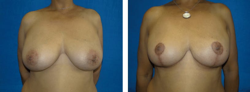 Breast Reduction Before & After Gallery - Patient 74827284 - Image 1