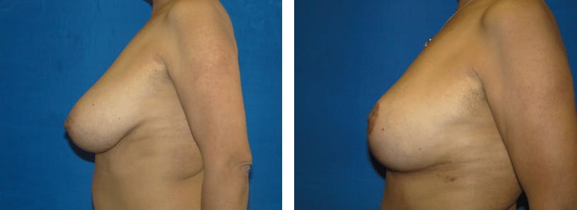 Breast Reduction Before & After Gallery - Patient 74827284 - Image 2