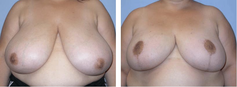 Breast Reduction Before & After Gallery - Patient 74827285 - Image 1