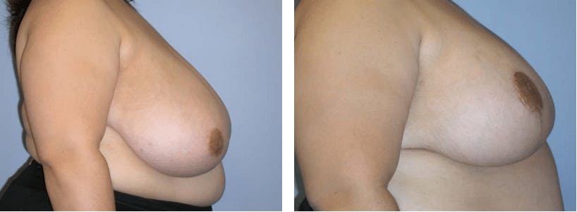 Breast Reduction Before & After Gallery - Patient 74827285 - Image 2