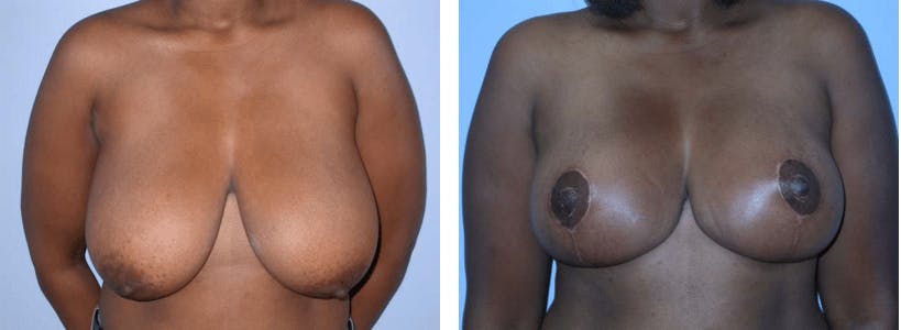 Breast Reduction Before & After Gallery - Patient 74827286 - Image 1