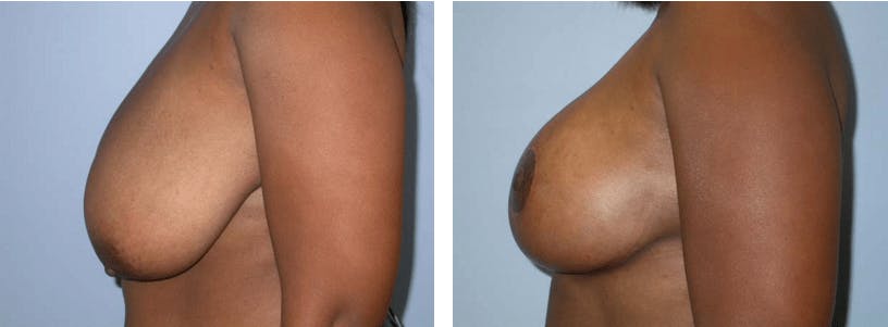 Breast Reduction Before & After Gallery - Patient 74827286 - Image 2
