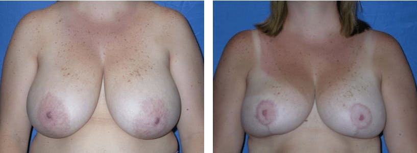 Breast Reduction Before & After Gallery - Patient 74827287 - Image 1