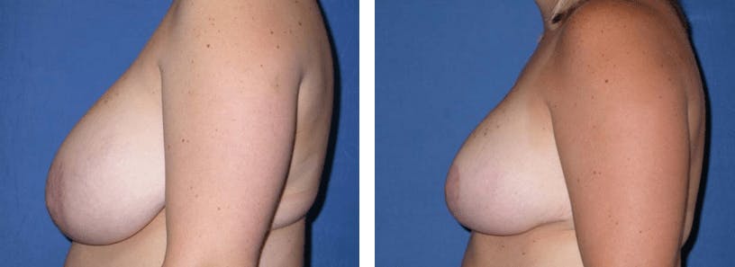 Breast Reduction Before & After Gallery - Patient 74827287 - Image 2
