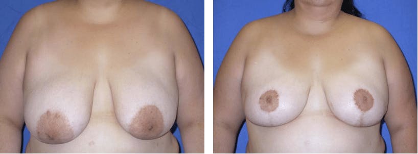 Breast Reduction Before & After Gallery - Patient 74827288 - Image 1