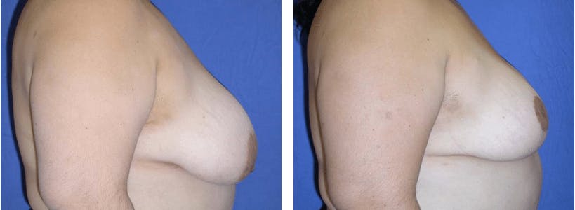 Breast Reduction Before & After Gallery - Patient 74827288 - Image 2