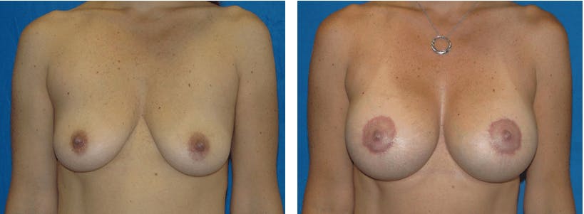 Breast Lift Gallery - Patient 74827315 - Image 1