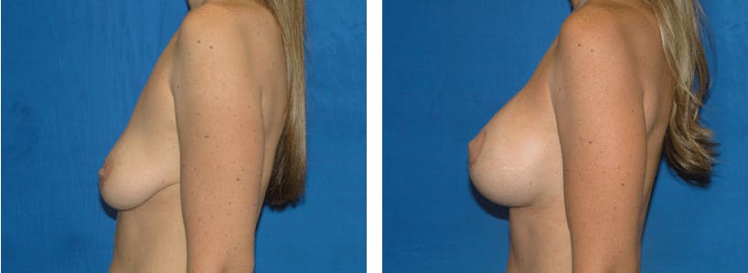 Breast Lift Before & After Gallery - Patient 74827315 - Image 2