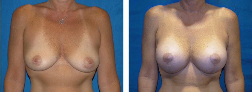 Breast Lift Before & After Gallery - Patient 74827317 - Image 1