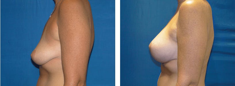 Breast Lift Before & After Gallery - Patient 74827317 - Image 2