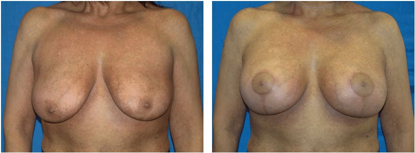 Breast Lift Before & After Gallery - Patient 74827318 - Image 1