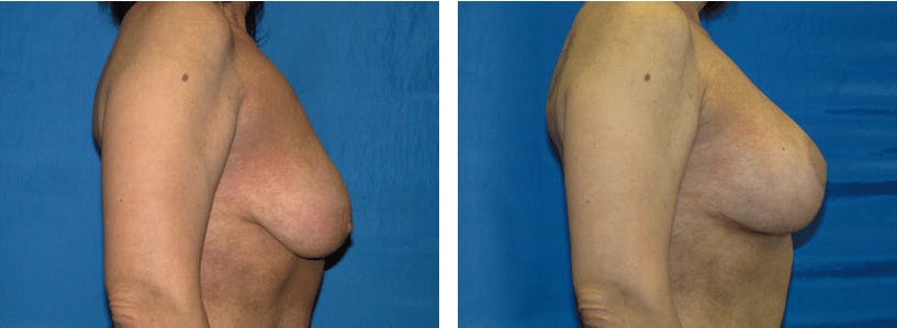 Breast Lift Before & After Gallery - Patient 74827318 - Image 2