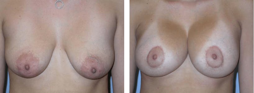 Breast Lift Gallery - Patient 74827345 - Image 1