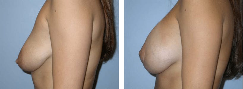 Breast Lift Before & After Gallery - Patient 74827345 - Image 2