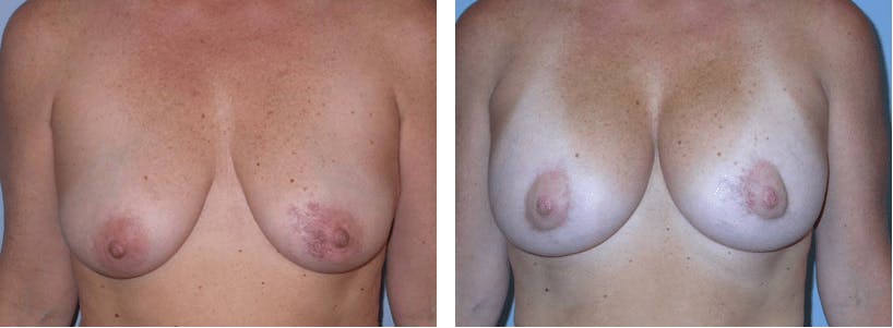 Before & After Breast Lift in Orange County