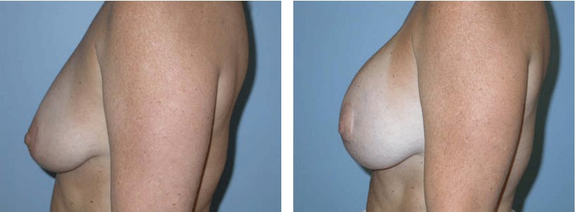 Breast Lift Before & After Gallery - Patient 74827372 - Image 2