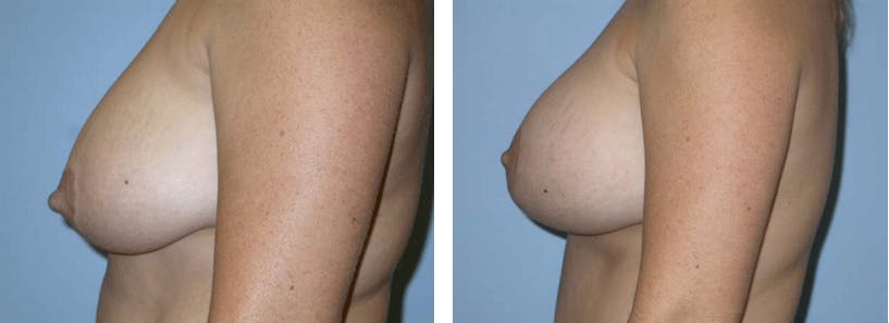 Breast Lift Before & After Gallery - Patient 74827373 - Image 2