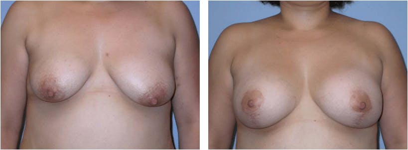 Breast Lift Before & After Gallery - Patient 74827374 - Image 1