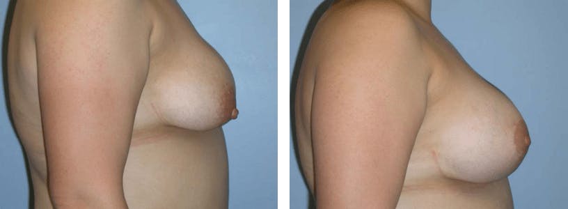 Breast Lift Before & After Gallery - Patient 74827374 - Image 2