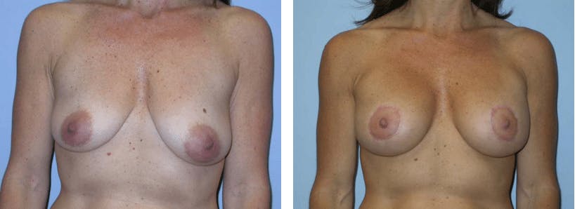 Breast Lift Before & After Gallery - Patient 74827401 - Image 1