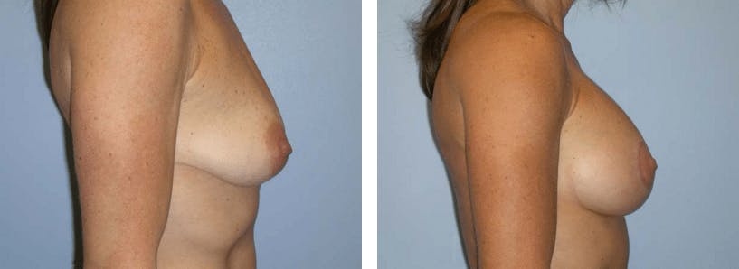 Breast Lift Before & After Gallery - Patient 74827401 - Image 2