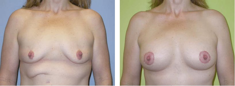 Breast Lift Before & After Gallery - Patient 74827402 - Image 1