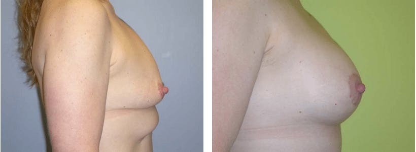 Breast Lift Gallery - Patient 74827402 - Image 2