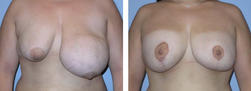 Breast Lift Before & After Gallery - Patient 74827403 - Image 1