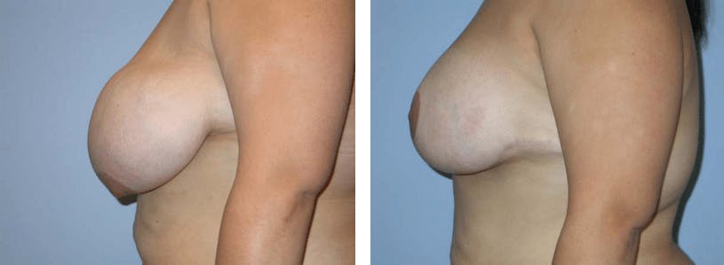 Breast Lift Before & After Gallery - Patient 74827403 - Image 2