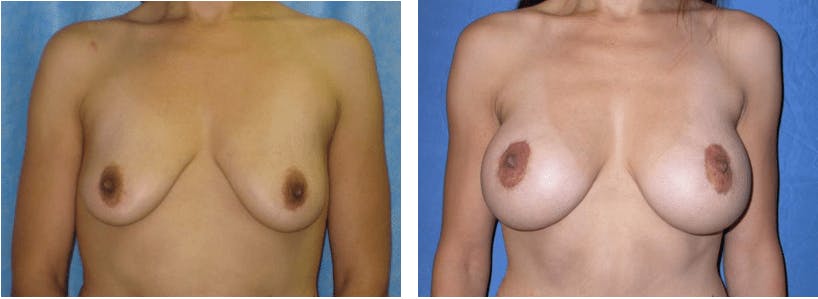 Breast Lift Before & After Gallery - Patient 74827407 - Image 1
