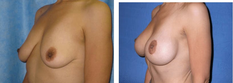 Breast Lift Gallery - Patient 74827407 - Image 2