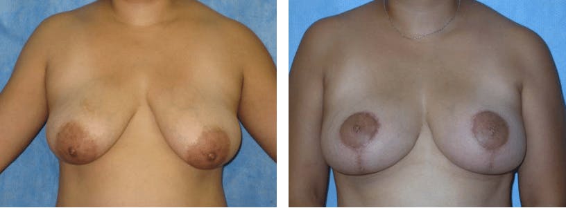 Breast Lift Before & After Gallery - Patient 74827408 - Image 1