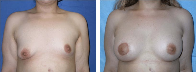 Breast Lift Gallery - Patient 74827435 - Image 1