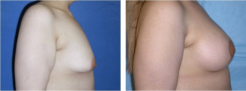 Breast Lift Before & After Gallery - Patient 74827435 - Image 2