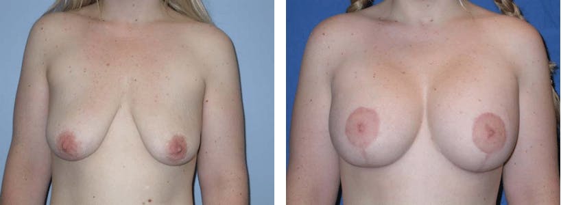 Breast Lift Before & After Gallery - Patient 74827436 - Image 1