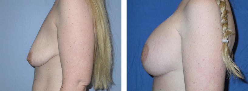 Breast Lift Before & After Gallery - Patient 74827436 - Image 2