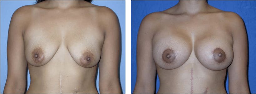 Breast Lift Before & After Gallery - Patient 74827437 - Image 1