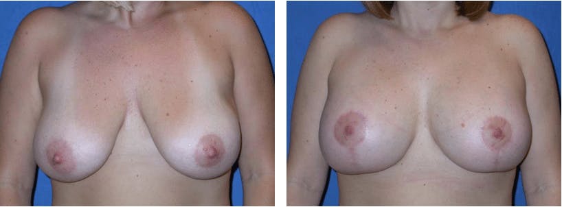 Breast Lift Before & After Gallery - Patient 74827438 - Image 1