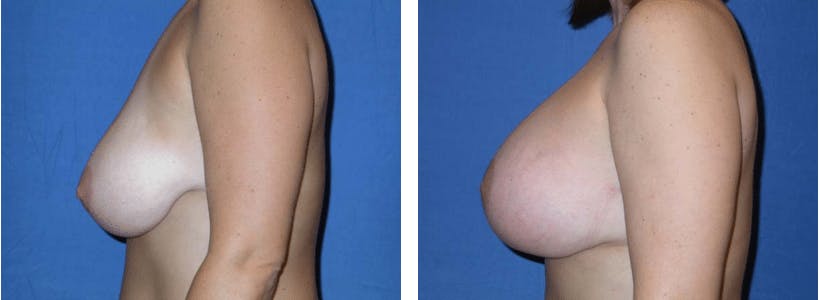 Breast Lift Before & After Gallery - Patient 74827438 - Image 2