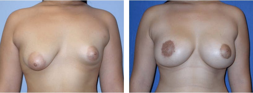 Breast Lift Before & After Gallery - Patient 74827439 - Image 1