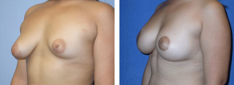 Breast Lift Before & After Gallery - Patient 74827439 - Image 2
