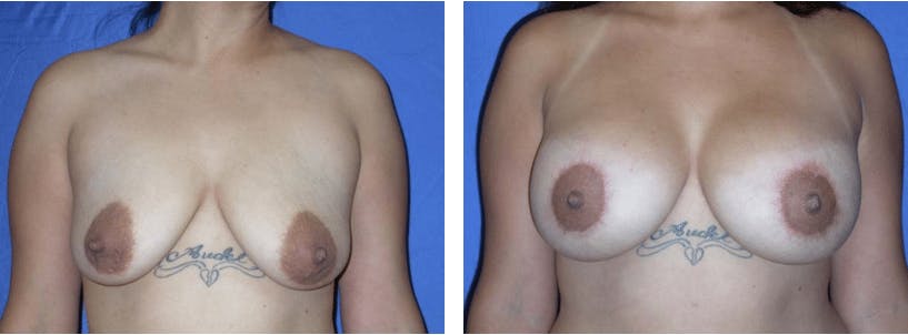 Breast Lift Gallery - Patient 74827440 - Image 1