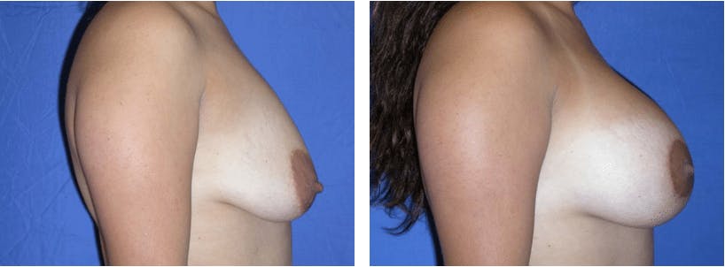 Breast Lift Before & After Gallery - Patient 74827440 - Image 2
