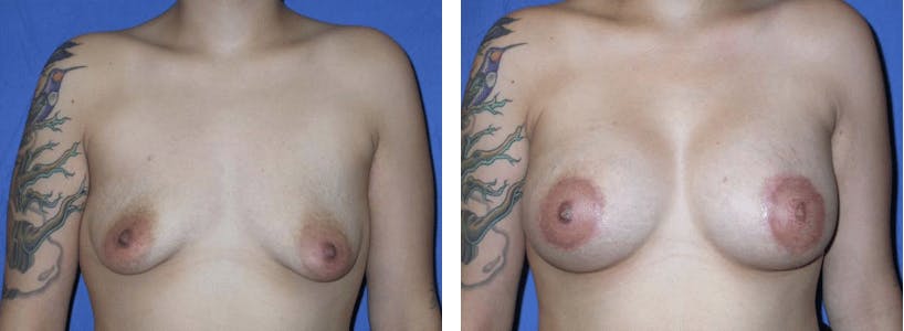 Breast Lift Before & After Gallery - Patient 74827441 - Image 1