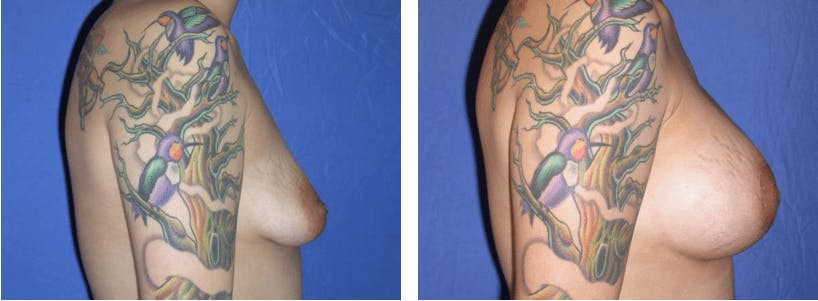 Breast Lift Before & After Gallery - Patient 74827441 - Image 2