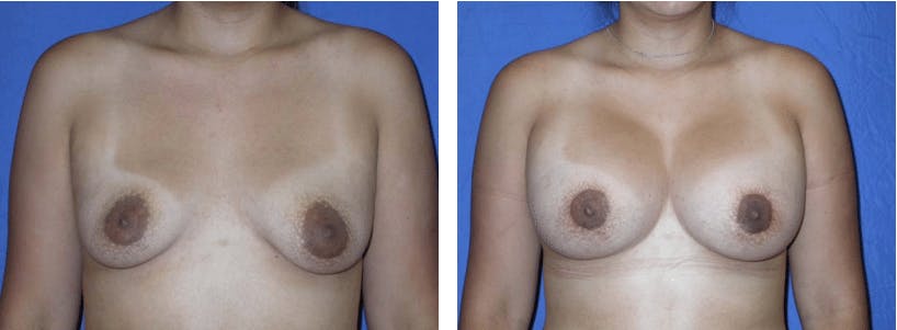 Breast Lift Before & After Gallery - Patient 74827442 - Image 1