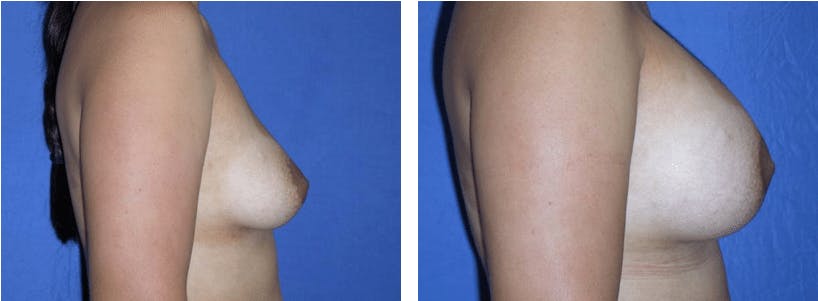 Breast Lift Before & After Gallery - Patient 74827442 - Image 2